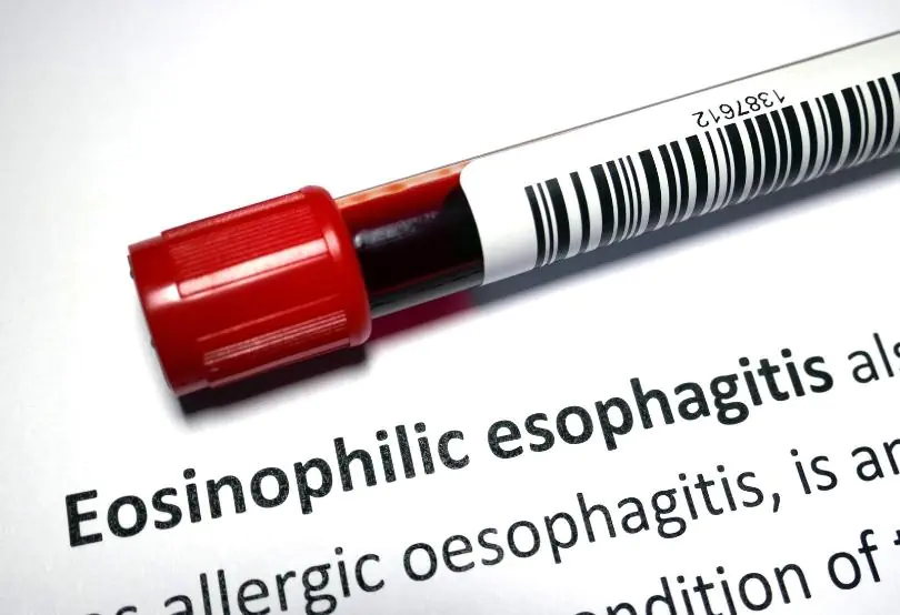 Eozinofilik kolit tedavisi nasıl yapılır